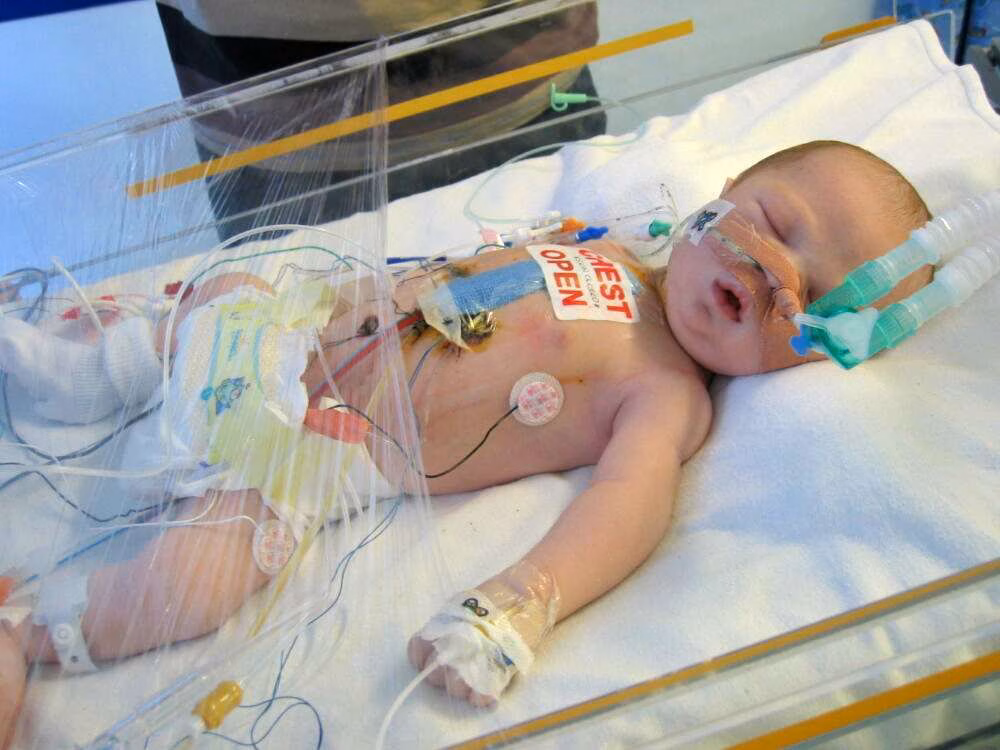Baby who had open heart surgery at BCH
