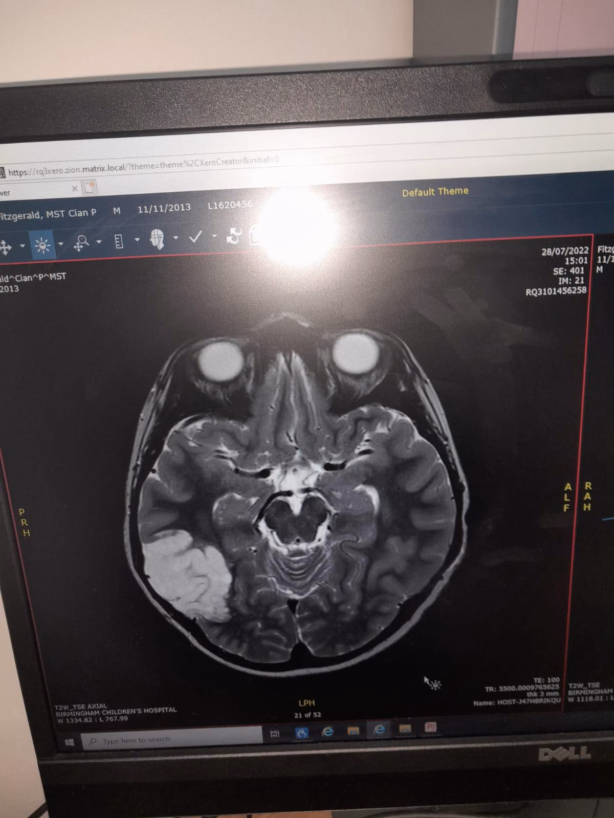 brain tumour scan